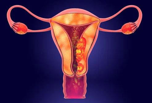 Uterine cancer